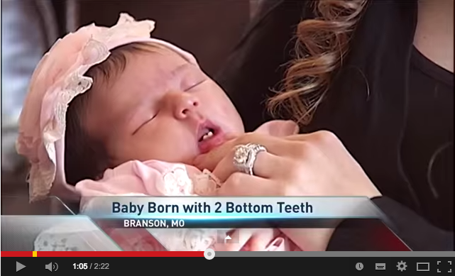 Bimba nasce con due dentini - il video