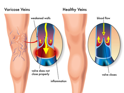 varicoza peptide care este sarcina pe picioare în varicoza