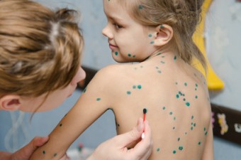 Lubrication zelenkoj chickenpox sores on the back of a little girl
