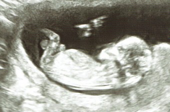 First Photographs - ecografia