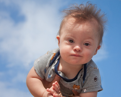 La bimba nasce down, ginecologo condannato