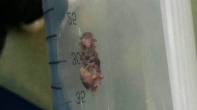 Pezzo di legno nei polmoni: rischia il soffocamento a 14 mesi