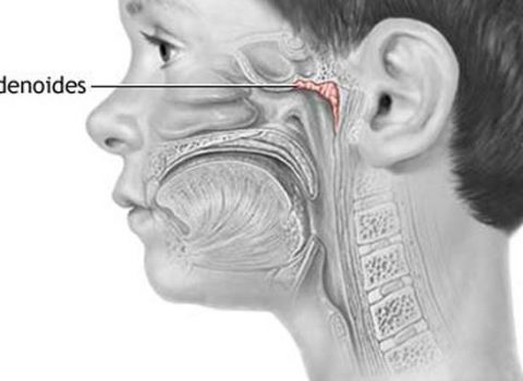 Adenoidi nel bambino: un'alternativa all'intervento in anestesia generale